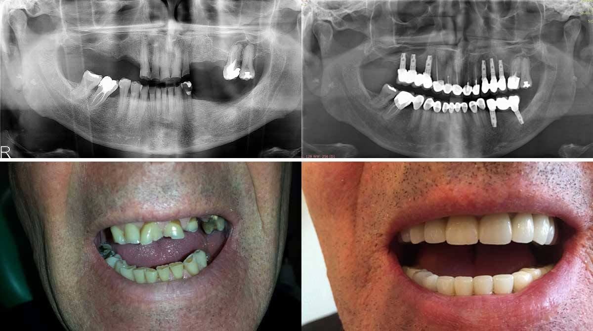 Dopo: Confronto clinico con radiografie panoramiche e sorriso prima e dopo il trattamento